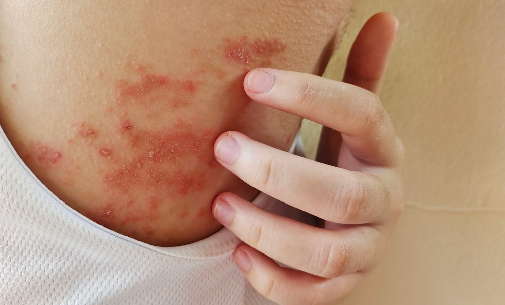 Eczema