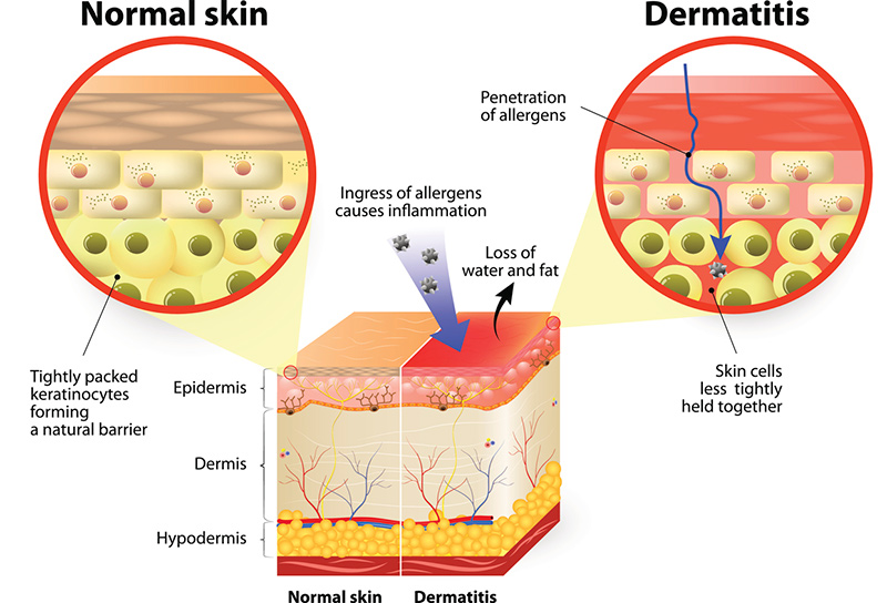 Eczema