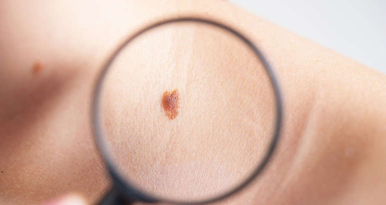 Skin Cancer Diagnosis, Treatment, and Removal
