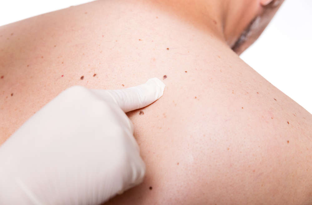 What To Expect At A Full Body Skin Cancer Exam