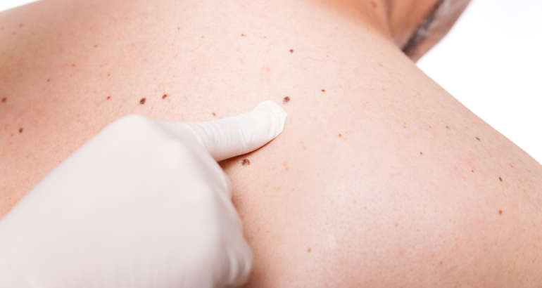 What Happens During a Skin Cancer Appointment?