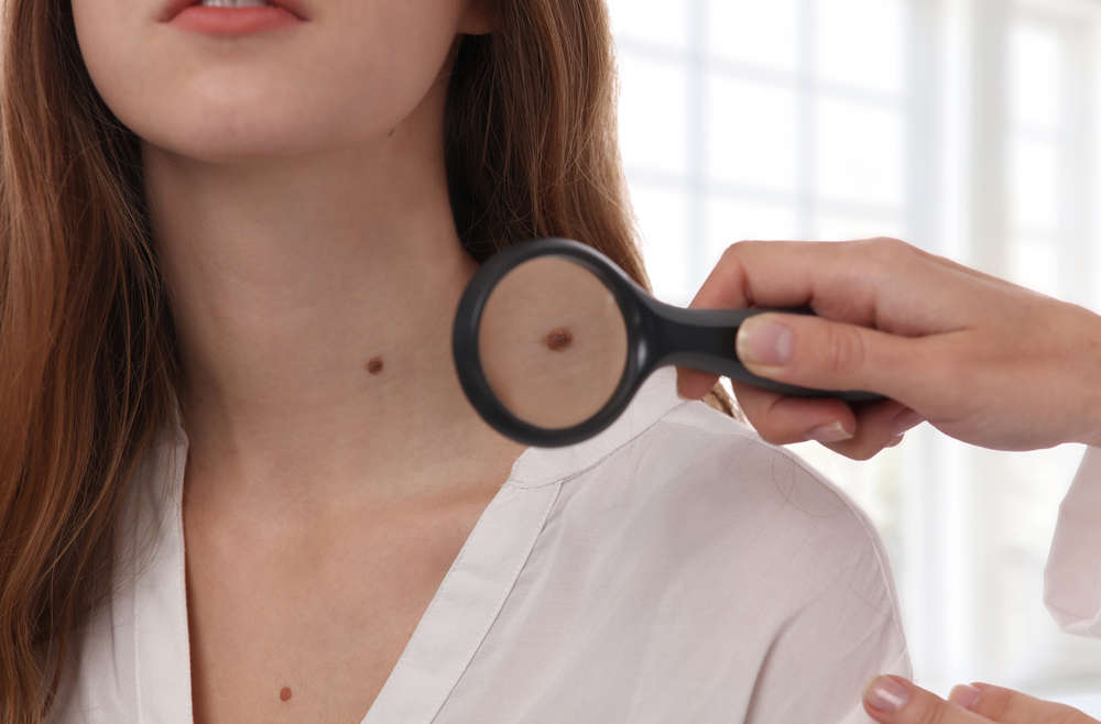 What to Expect from Mole Removal