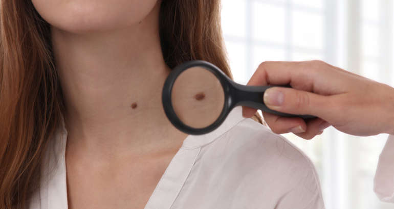 What to Expect from Mole Removal