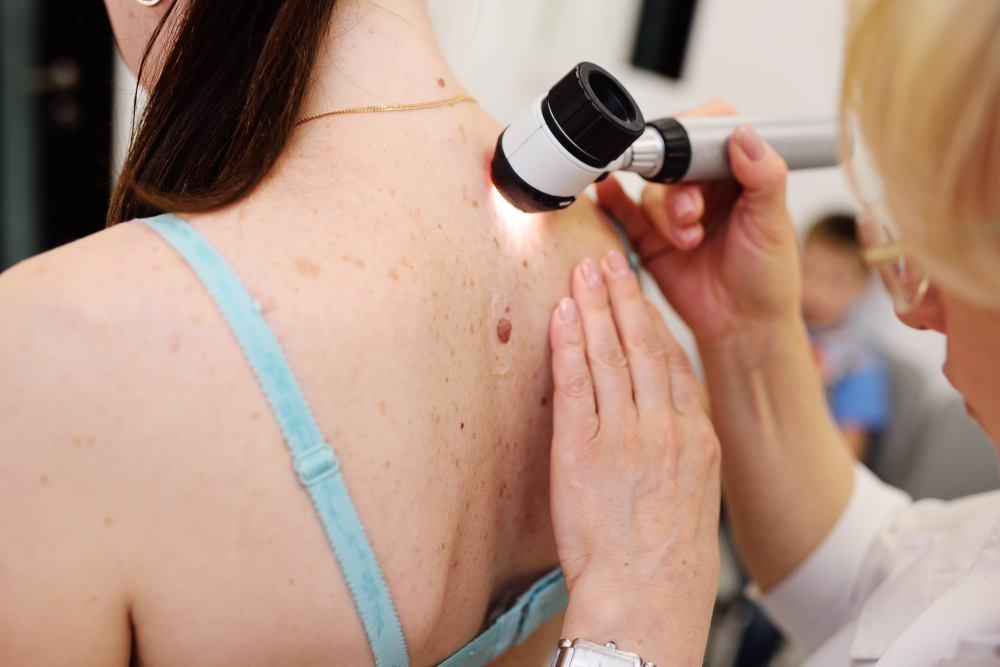 What Are the Early Signs of Skin Cancer?