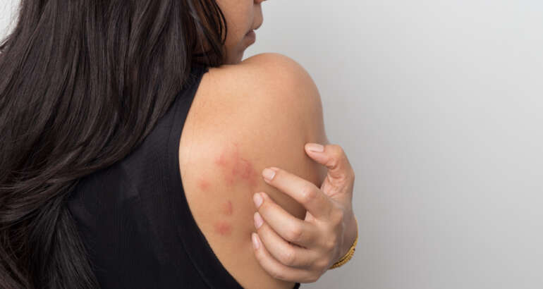 Do I Have a Rash, and When Should I Go to the Dermatologist?