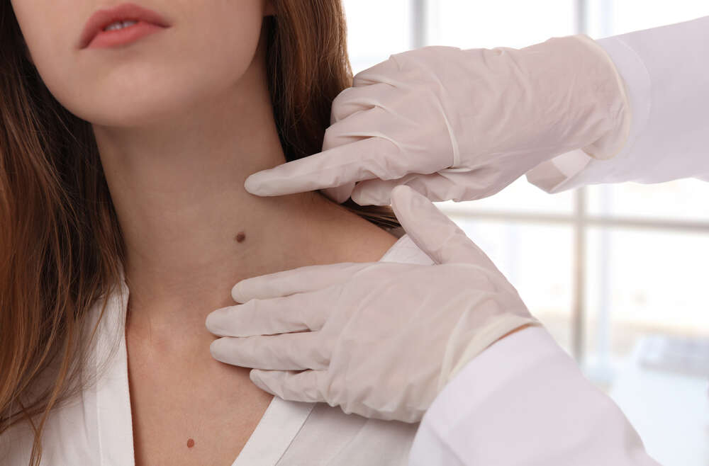 Does Insurance Cover Skin Tag Removal?
