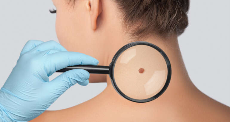 For the Top Skin Cancer Specialist in Marietta, Georgia, Follow These 6 Tips!