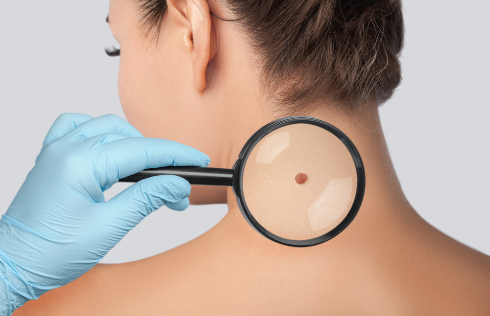 For the Top Skin Cancer Specialist in Marietta, Georgia, Follow These 6 Tips!