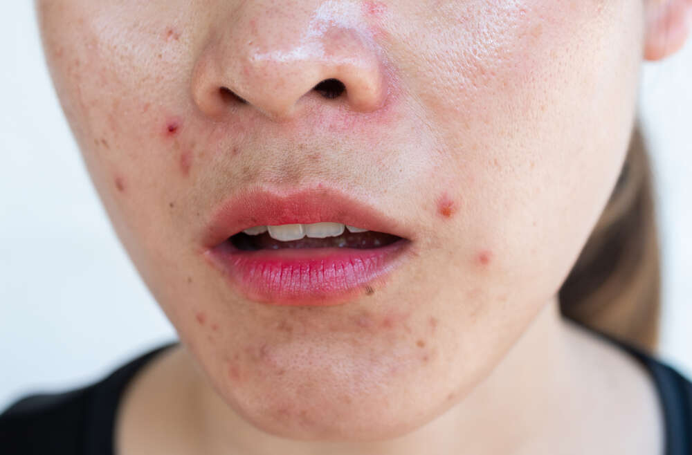 Finding An Acne Specialist in Marietta, Georgia