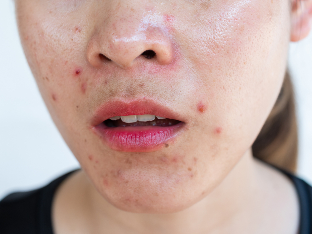 Finding An Acne Specialist in Marietta Georgia