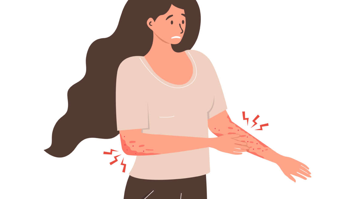 Psoriasis Diagnosis and Treatment