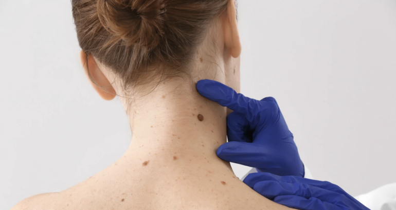 Here’s How to Find the Best Skin Cancer Specialist in Carrollton, Georgia