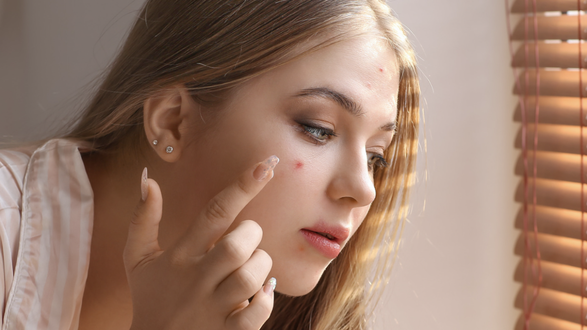 Your Trusted Acne Specialist in Rockmart, Georgia