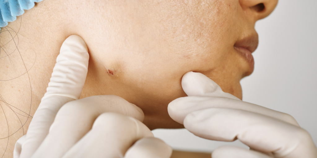 Acne Dermatologist in Cartersville