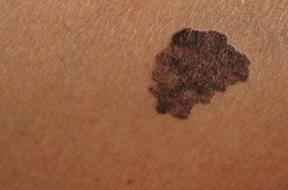 Why You Need a Black Dermatologist in Cartersville, GA if You Have Skin of Color