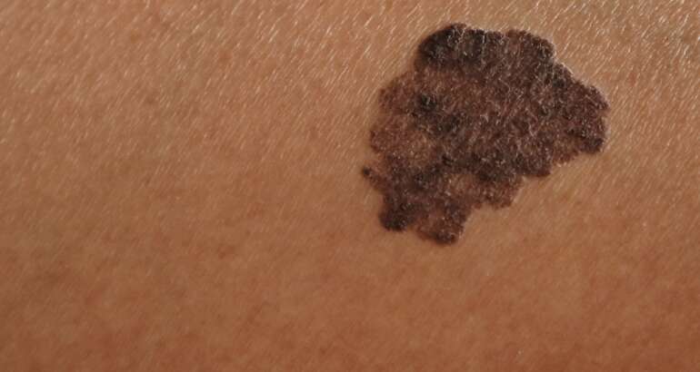 Why You Need a Black Dermatologist in Cartersville, GA if You Have Skin of Color