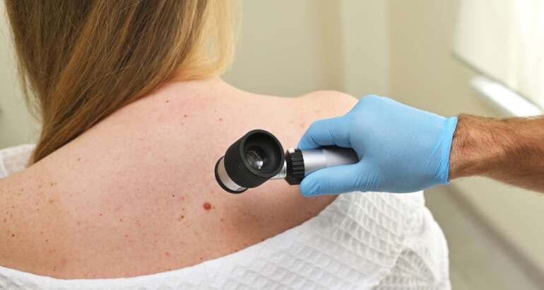 Find the Top Skin Cancer Doctor in Marietta, GA for Mohs Surgery With These 4 Simple Tips