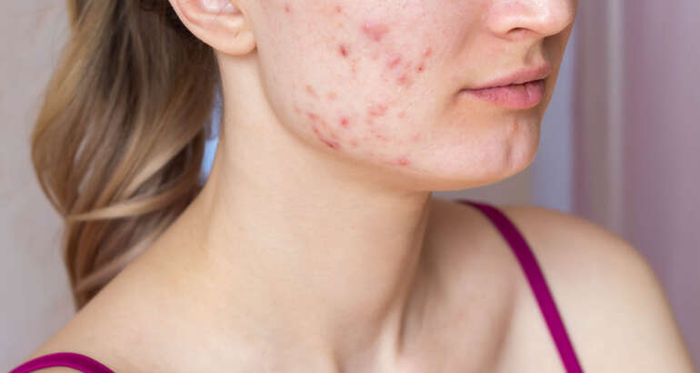 When to See the Best Acne Specialist in Kennesaw, GA 