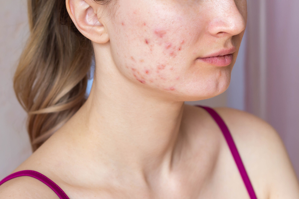 When to See the Best Acne Specialist in Kennesaw GA