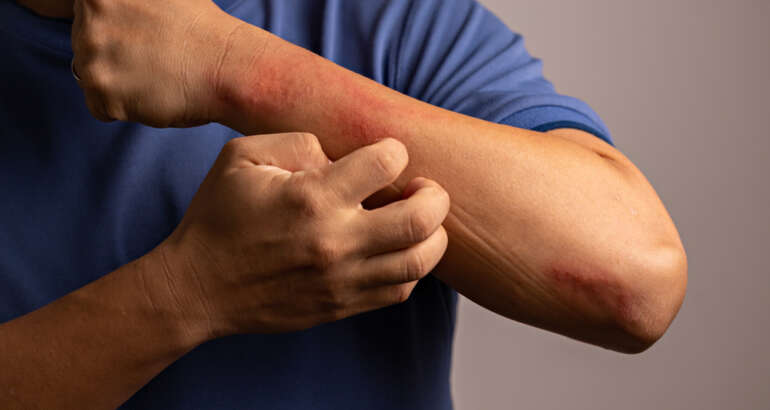 See a Same-Day Emergency Rash Doctor Near Kennesaw, Georgia for These 4 Signs