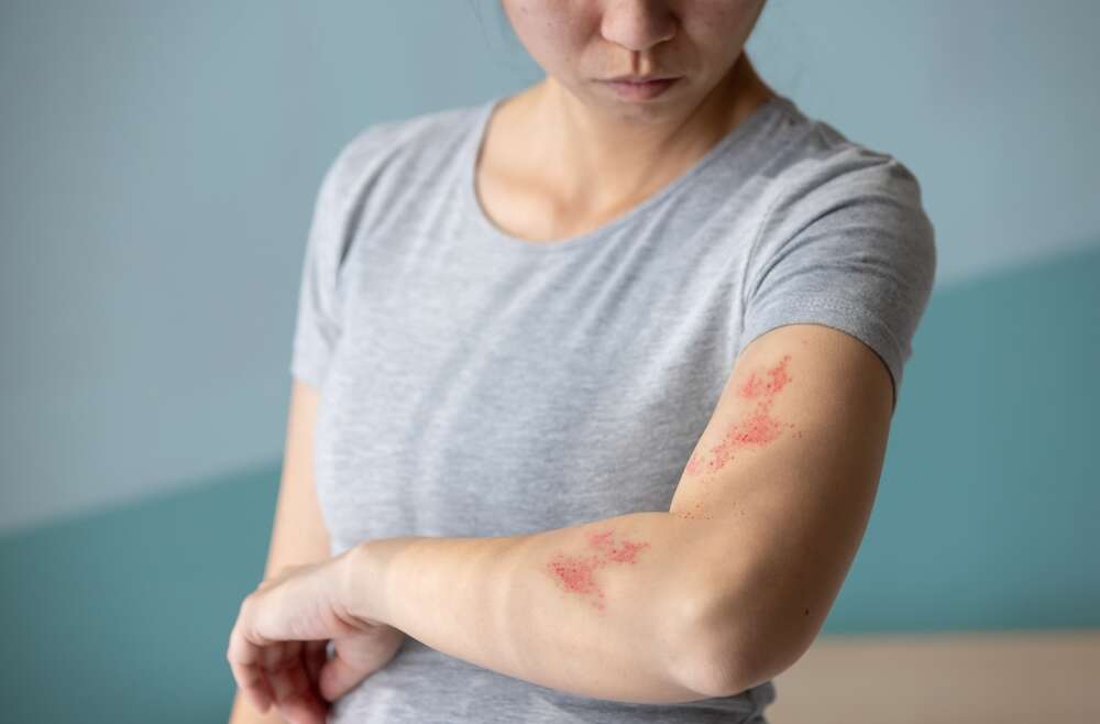 Immediate Relief: Same-Day Rash Dermatology Appointments in and Around Kennesaw, GA