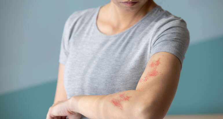 Immediate Relief: Same-Day Rash Dermatology Appointments in and Around Kennesaw, GA