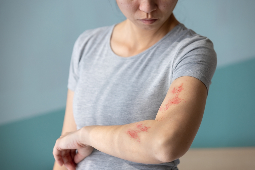 Same-Day Rash Dermatology Appointments in and Around Kennesaw