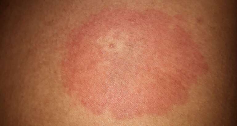 Get Same-Day Dermatology Help for Rash Emergencies Near Marietta, Georgia 