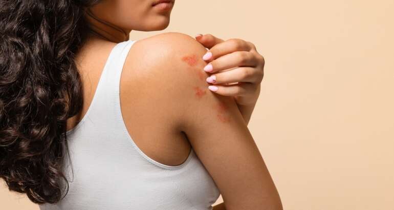 Emergency Dermatology for Rash Treatment in Marietta, GA: Same-Day Appointments Available 