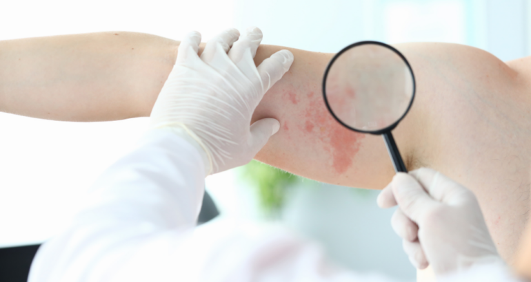 How to Find a Same-Day Dermatology Clinic Near Roswell, Georgia