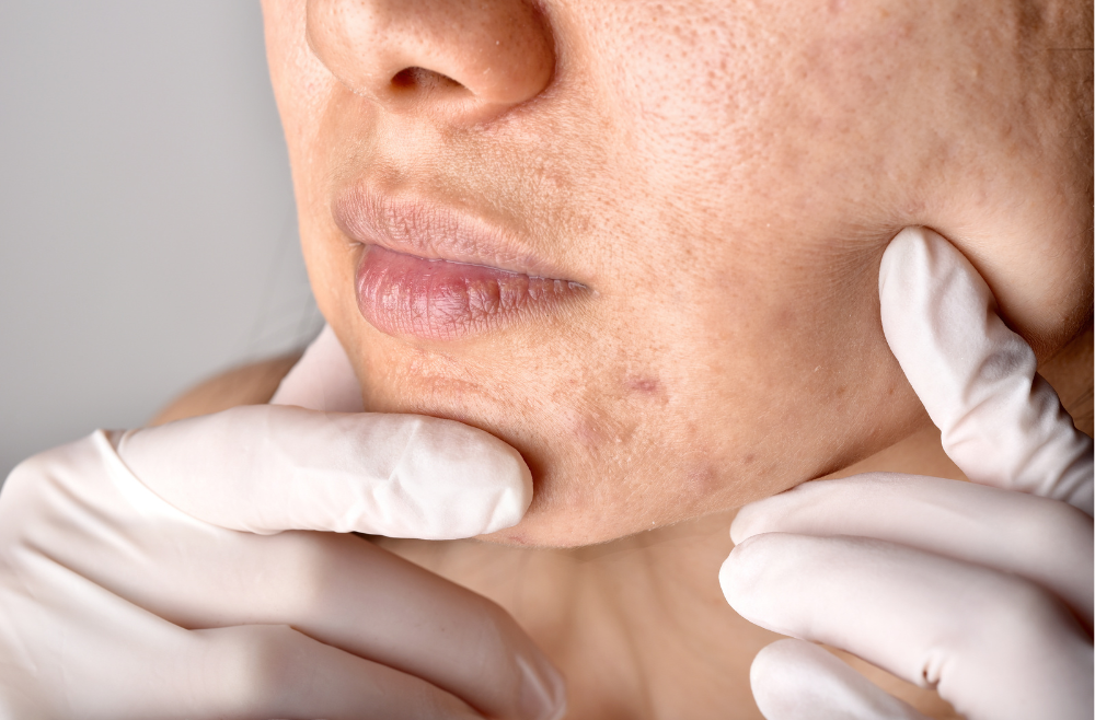 How to Find the Best Acne Treatment Dermatologist in Acworth, GA?