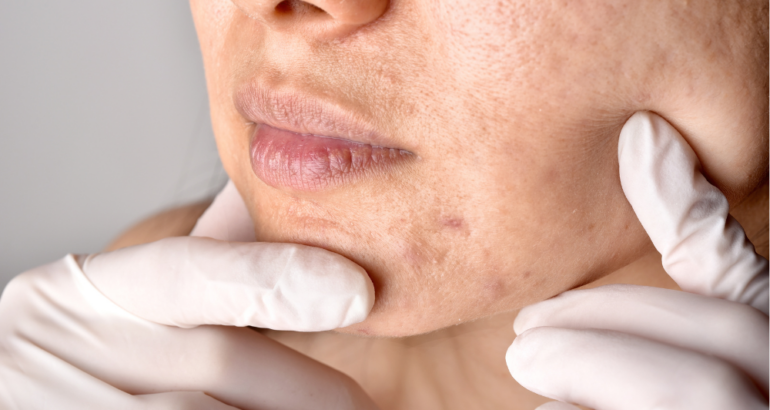 How to Find the Best Acne Treatment Dermatologist in Acworth, GA?
