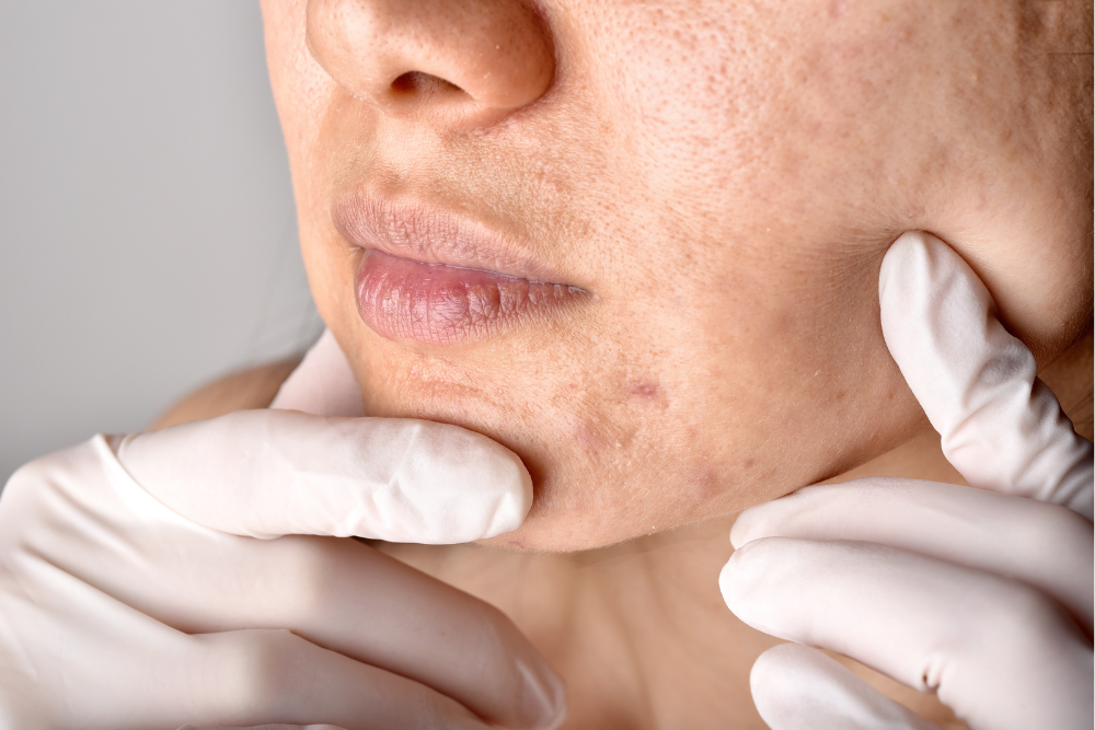 best acne treatment dermatologist Acworth GA