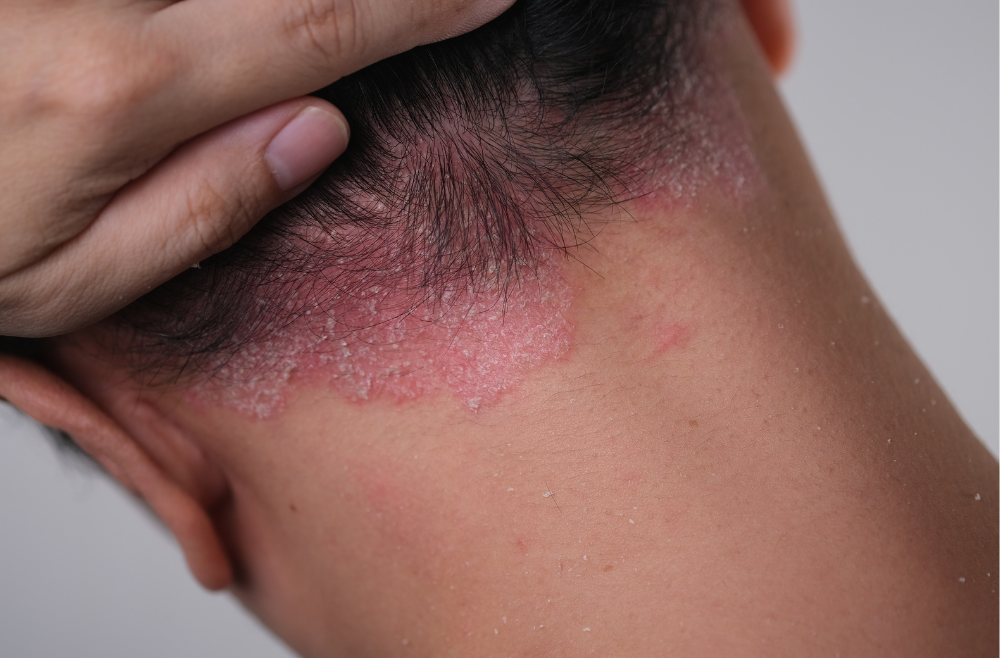 What Does Psoriasis Look Like?
