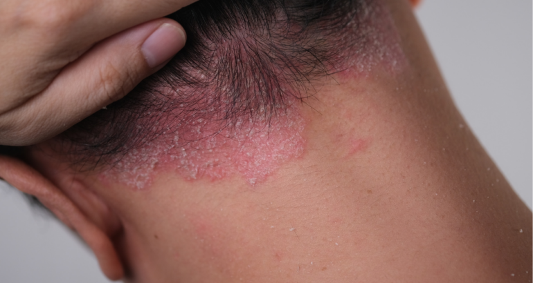 What Does Psoriasis Look Like?