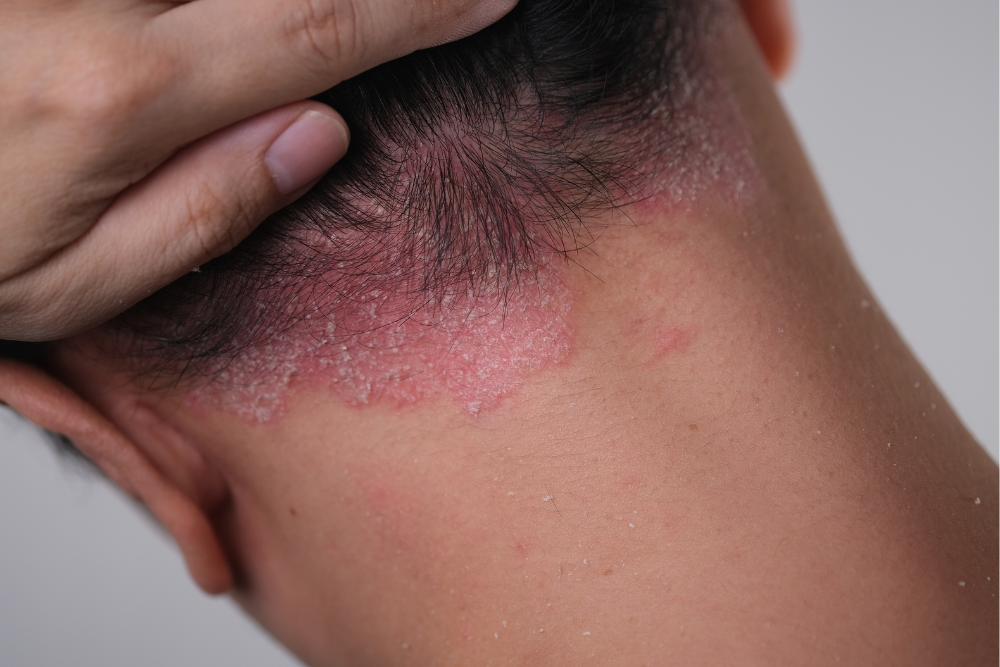 what does psoriasis look like