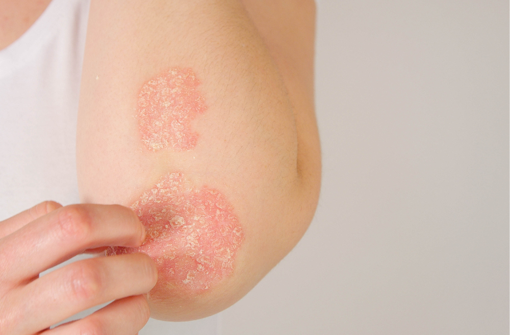 Where Does Psoriasis Show Up?