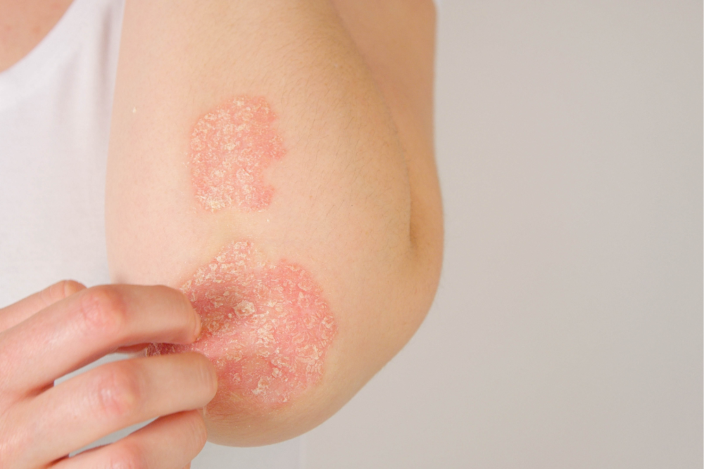 where does psoriasis show up?