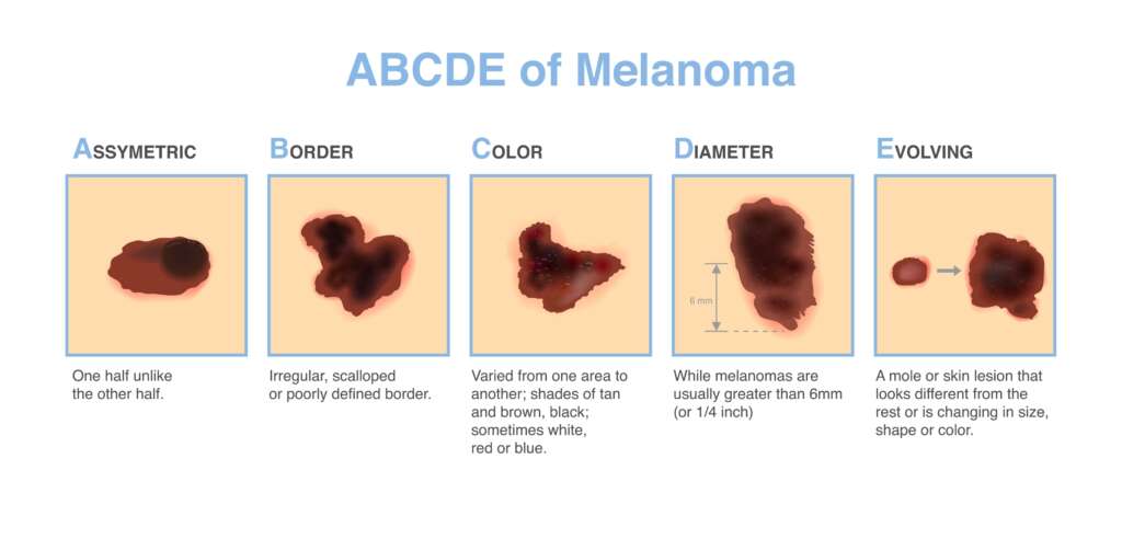 ABCDE of Skin Cancer in Georgia