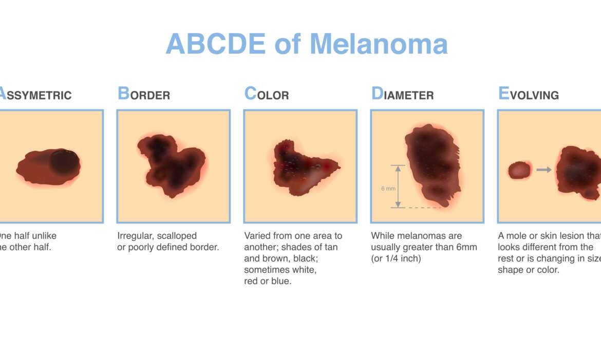 Understanding Melanoma in Georgia: The ABCDE of Skin Cancer 