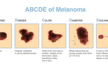 Understanding Melanoma in Georgia: The ABCDE of Skin Cancer 