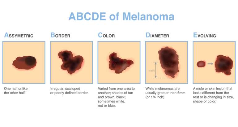 Understanding Melanoma in Georgia: The ABCDE of Skin Cancer 