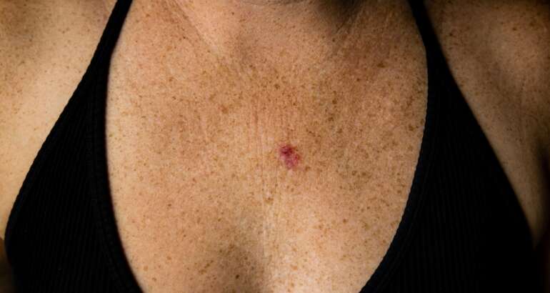 A Comprehensive Guide to Basal Cell Carcinoma