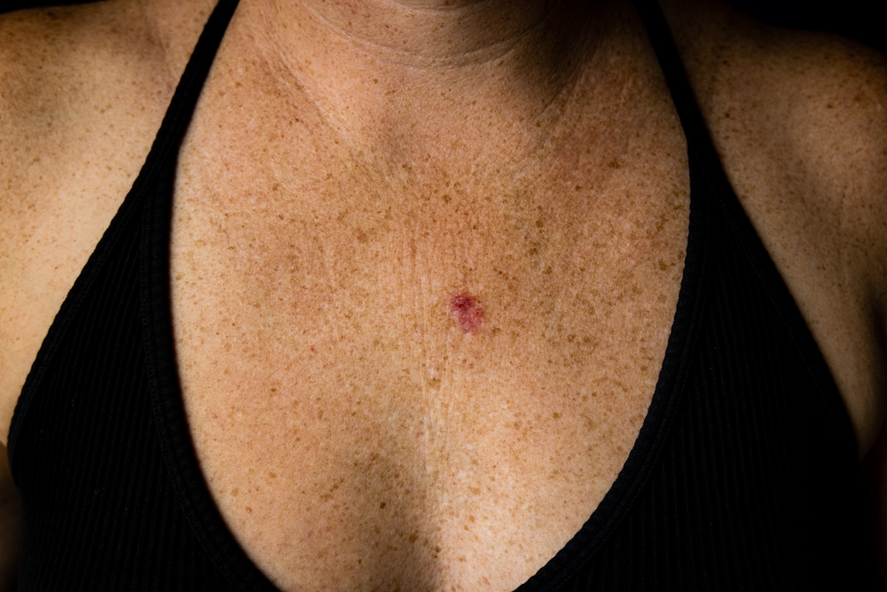 Basal Cell Carcinoma Georgia