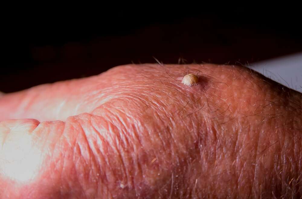 A Comprehensive Guide to Squamous Cell Carcinoma