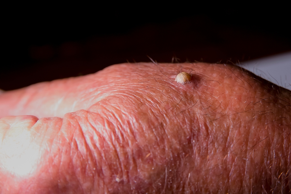 Squamous Cell Carcinoma Georgia