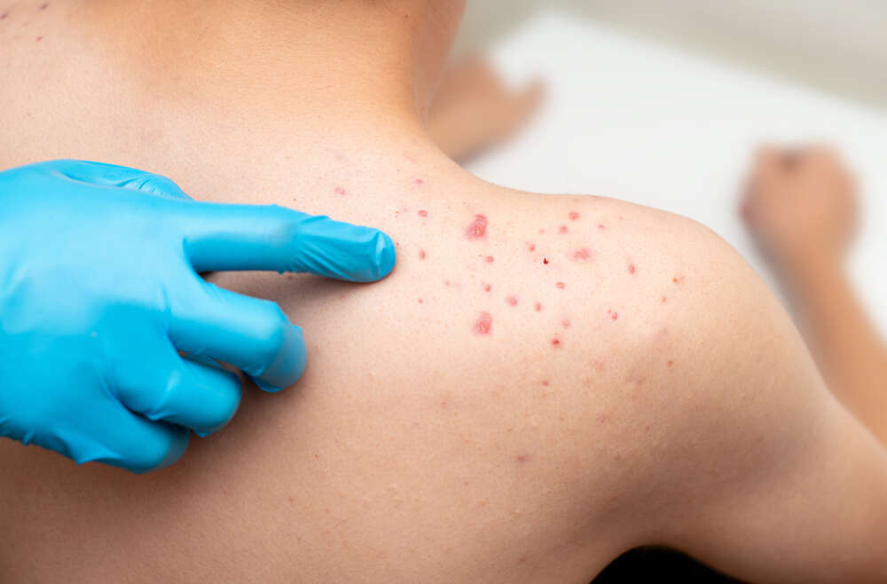 When Is the Right Time to See an Acne Specialist Near Marietta, GA