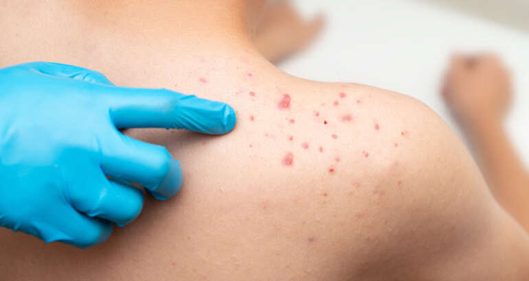 When Is the Right Time to See an Acne Specialist Near Marietta, GA