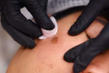 Why You Should Visit a Melasma Specialist Near Kennesaw, Georgia