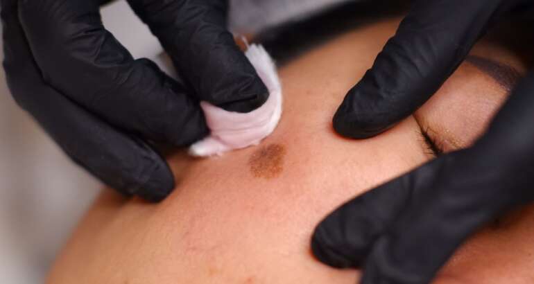 Why You Should Visit a Melasma Specialist Near Kennesaw, Georgia